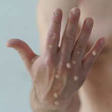 Hand with monkeypox rash 