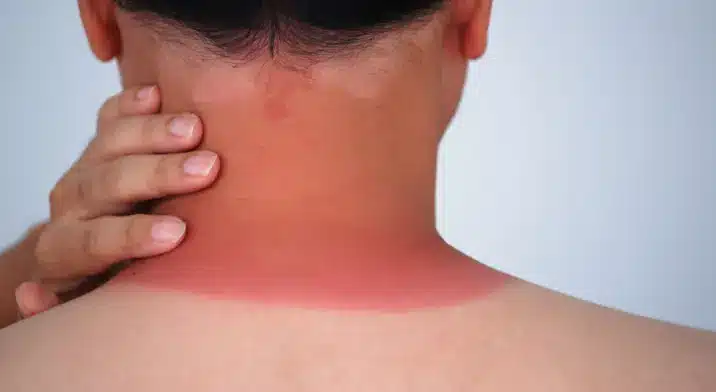 Man with bad sunburn on neck