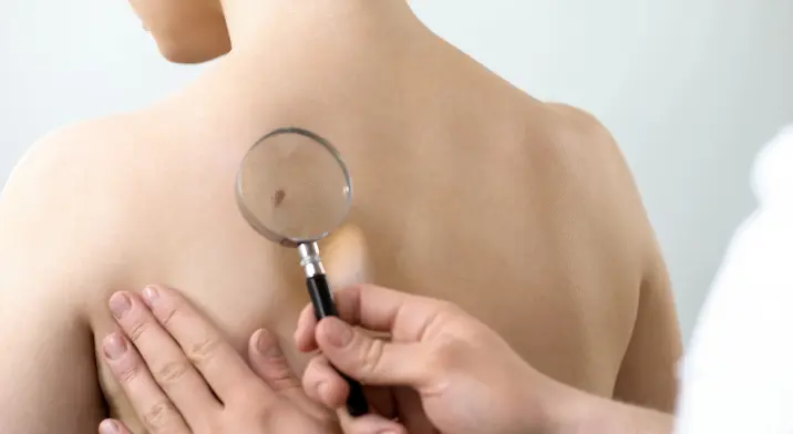 Doctor looking at mole on back of a person