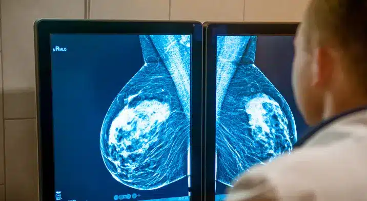 Mammogram